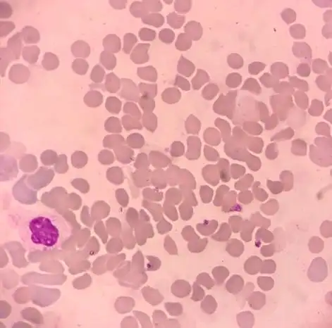 自身免疫性溶血性贫血引起的血标本红细胞凝集