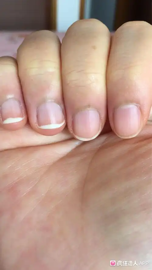 孕中期指甲发白