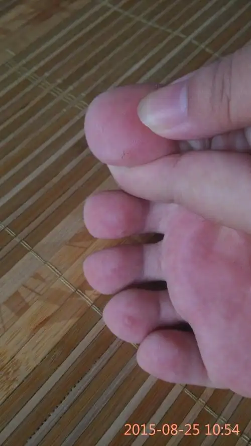 大脚趾最大,二脚趾和四脚趾也有,最开始大脚趾就一个小透明疙瘩,发展
