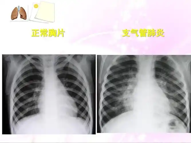 肺炎病人的护理ppt