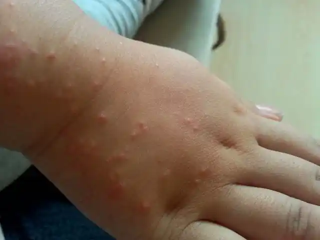 孩子过敏起疙瘩怎么办 三岁孩子过敏起疙瘩怎么办