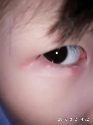 孩子8岁了,这几天眼睑下方边缘部位长了一个红色小疙瘩,不痛不痒,这几