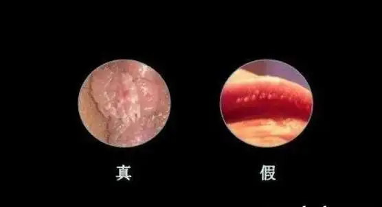 尖锐湿尤图症状图片男性初期疣体是什么样子