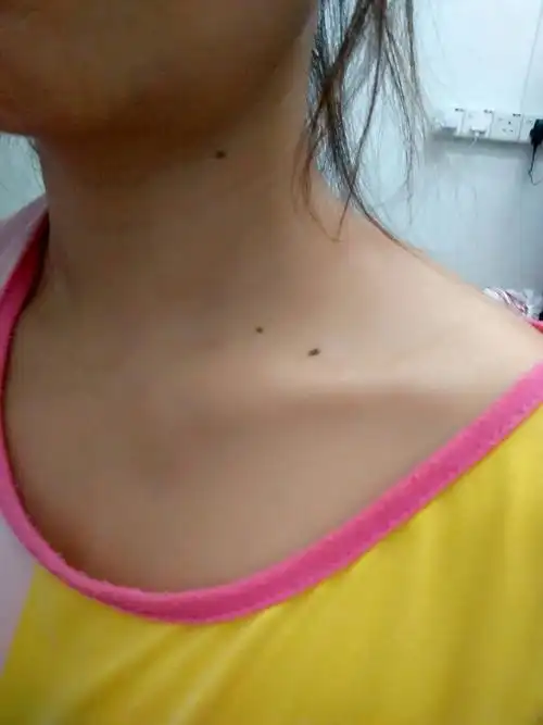 左边脸比右边脸松弛_右边脸长痣好不好_你的侧脸依旧好看,只是我的