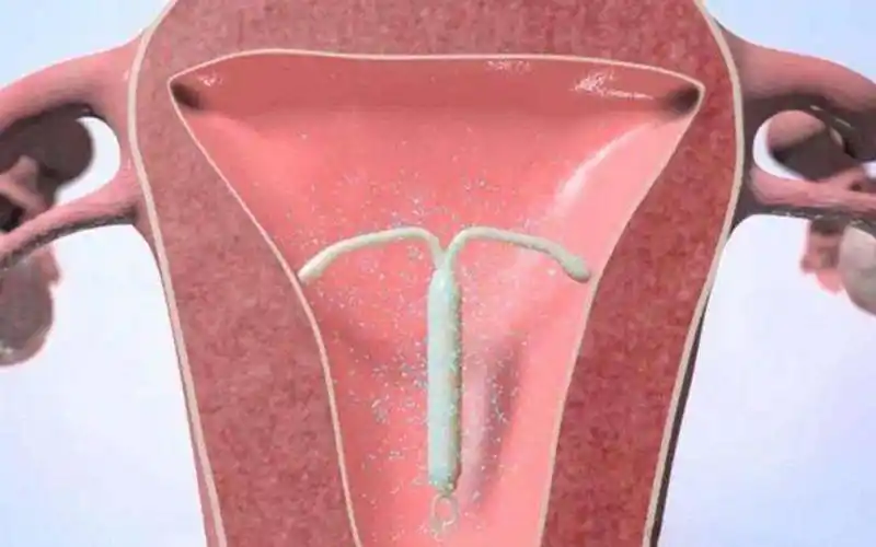 节育环放置过程图片? - 天津助孕【助孕这家好】天津_天津助孕