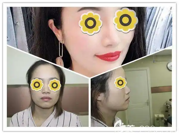 小姐姐做硅胶假体隆鼻前后对比图