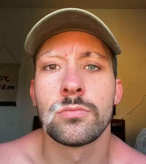 但是通过手术切除了这是我的马凡氏综合症手我给你五个手指患有瓦登