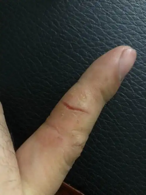 手指皮肤干裂,发硬,掉皮,不是一两处,裂的厉害了,就开口出血,是什么