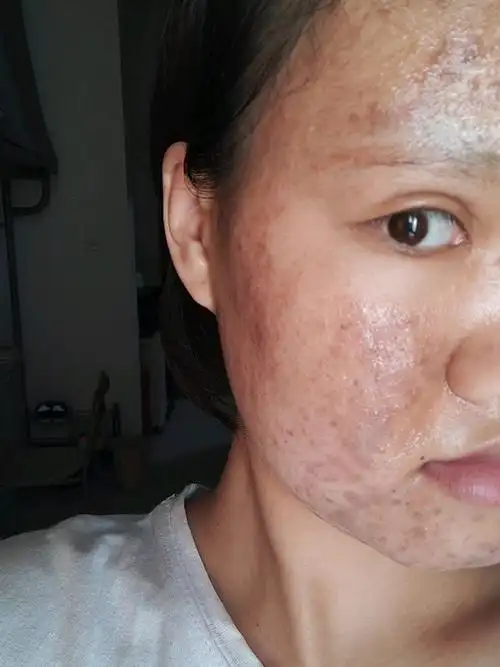 刷酸第一天大面积深色结痂【果酸焕肤】【果酸焕肤】淡_圈子-新氧美容