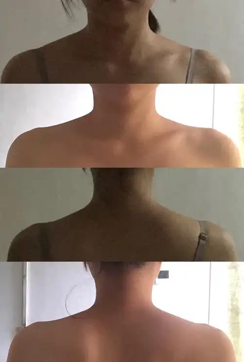 周六野斜方肌坚持一周对比,讲真好像有点用野