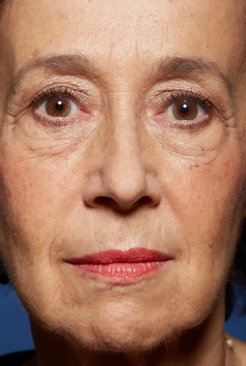 天生遗传眼袋怎么消除  眼袋是由于眼部周围皮肤松弛,浮肿和脂肪过多