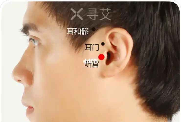 今日养生  经常艾灸听宫穴,耳门穴,听会穴,有助于促进局部血液循环