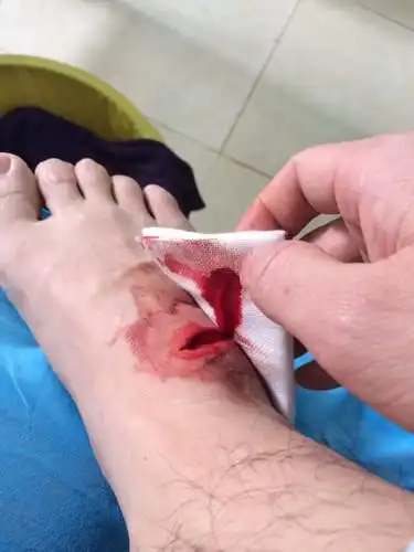 工伤怎么鉴定啊.我脚筋上班碰断了.现在接上了丶十几针.还打石膏了 不