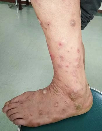 江西频道_凤凰网犬疥螨传染性皮肤病(疥疮性皮炎)疥疮是怎么引起哪