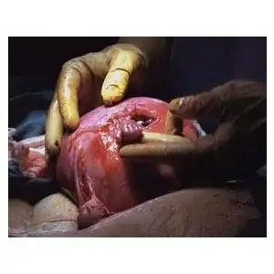 人流胎儿图_人流_可视人流_人流胎儿图_人流手术实拍图_求医网图片库