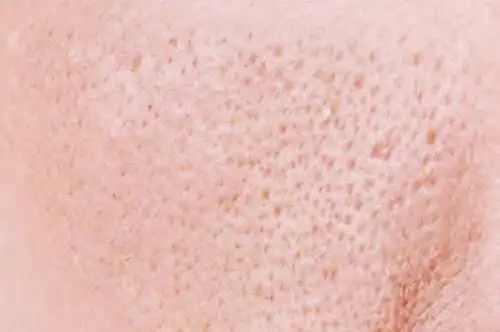 皮肤管理——毛孔粗大怎么改善_角质