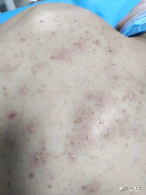 如何去背部痘印