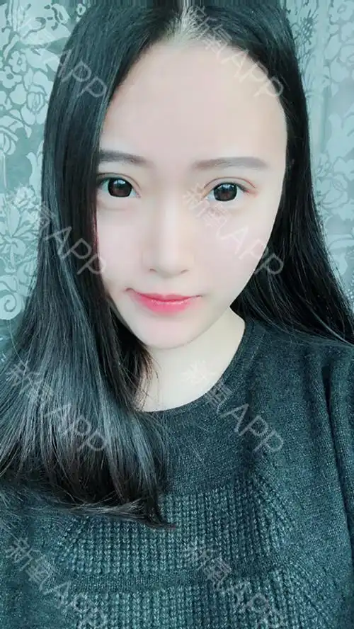 不知不觉在美莱做完双眼皮手术都20天左右了,现在眼_圈子-新氧美容