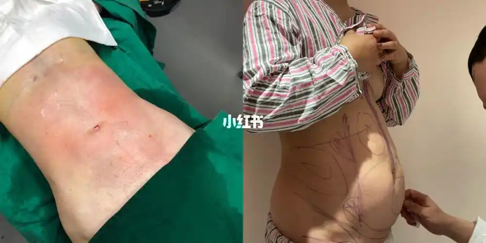 腰腹环吸_腰腹_环吸_腰腹环吸_减肥_减肥医药