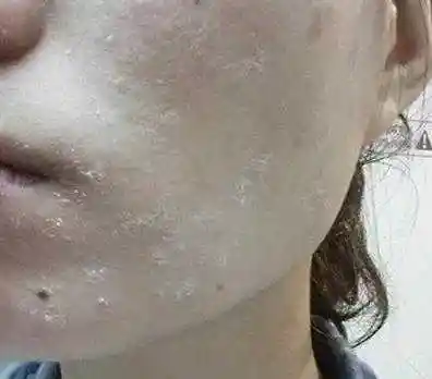 皮肤干燥紧绷怎么办?