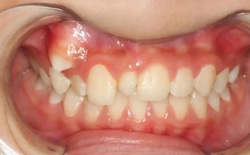 父母晒孩子双排牙齿,还以为是孩子"发育好",网友:赶紧送医院