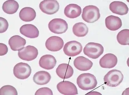 临床基本功│红细胞异常知多少