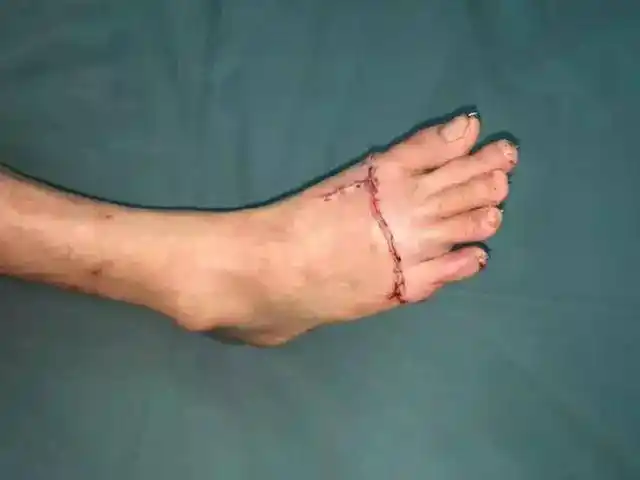 断足再植是断肢中最为困难的手术,手术体位置放困难,术中需要屈膝屈髋