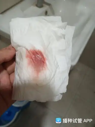 今天移植第8天   早上5天起来上厕所  发现有血