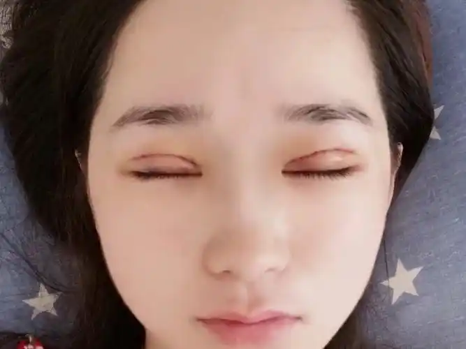 我比较喜欢平扇形双眼皮,它综合了扇形和平行的特点,_圈子-新氧美容