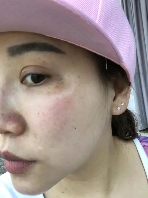 眼角下面长斑.皮肤暗黄 脸颊毛孔粗大._新氧美容整形