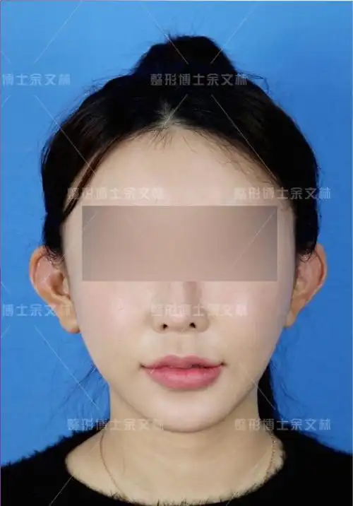 案例分析取软肋骨做贴发耳矫正术材料对人体有影响吗