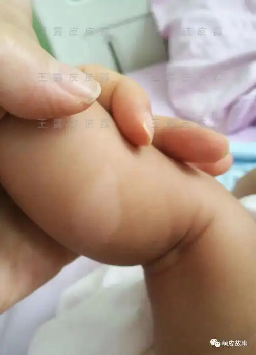 为什么会得贫血痣 为什么会出现贫血痣