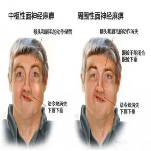 面部神经炎图解图片