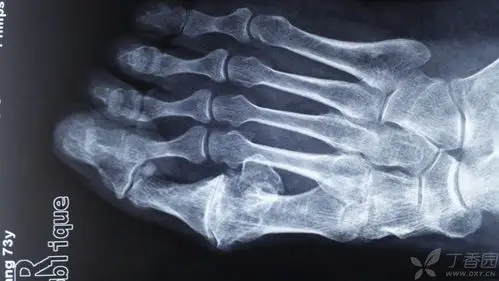 73岁男性,右足第一跖趾关节疼痛10年 - 骨科 -丁香园论坛