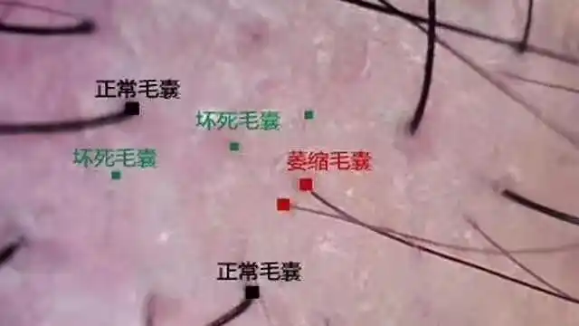 那么你的毛囊一定是出问题了