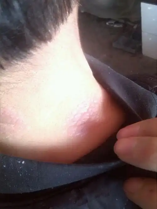 脖子上长癣怎么办