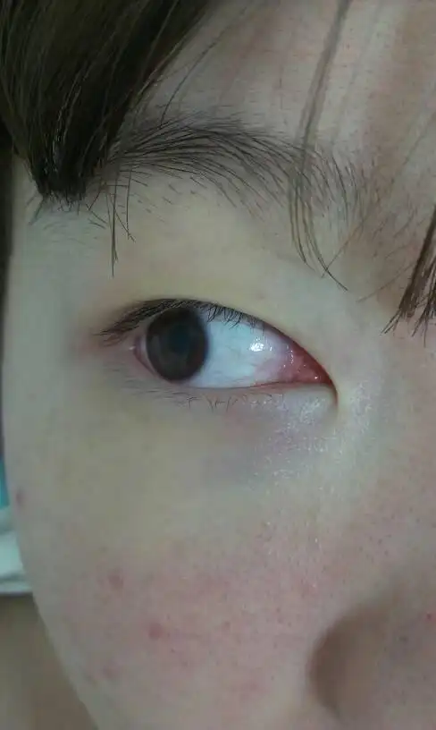 我每次带完隐形眼镜眼睛都有很多红血丝,会不会影响眼睛?