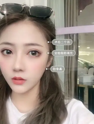 分享一个自己肋骨鼻77全脸脂肪填充 术后恢复全过程 _圈子-新氧美容