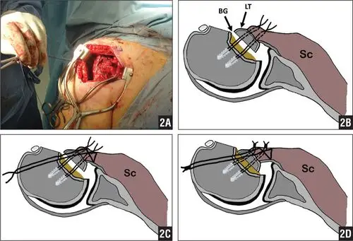 modified mclaughlin technique for neglected locked p