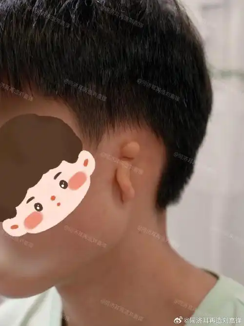 小耳畸形##同济耳再造专家刘嘉锋##老刘的日常