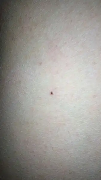 最近大腿内侧长了一个凸起的痣,黑色,触摸有点硬 仿佛是个小疙瘩,左侧