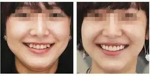 真人案例 | 牙知道虎牙矫正前后对比有差距