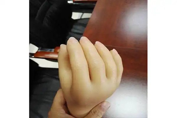 手指假肢的设计特点及分类