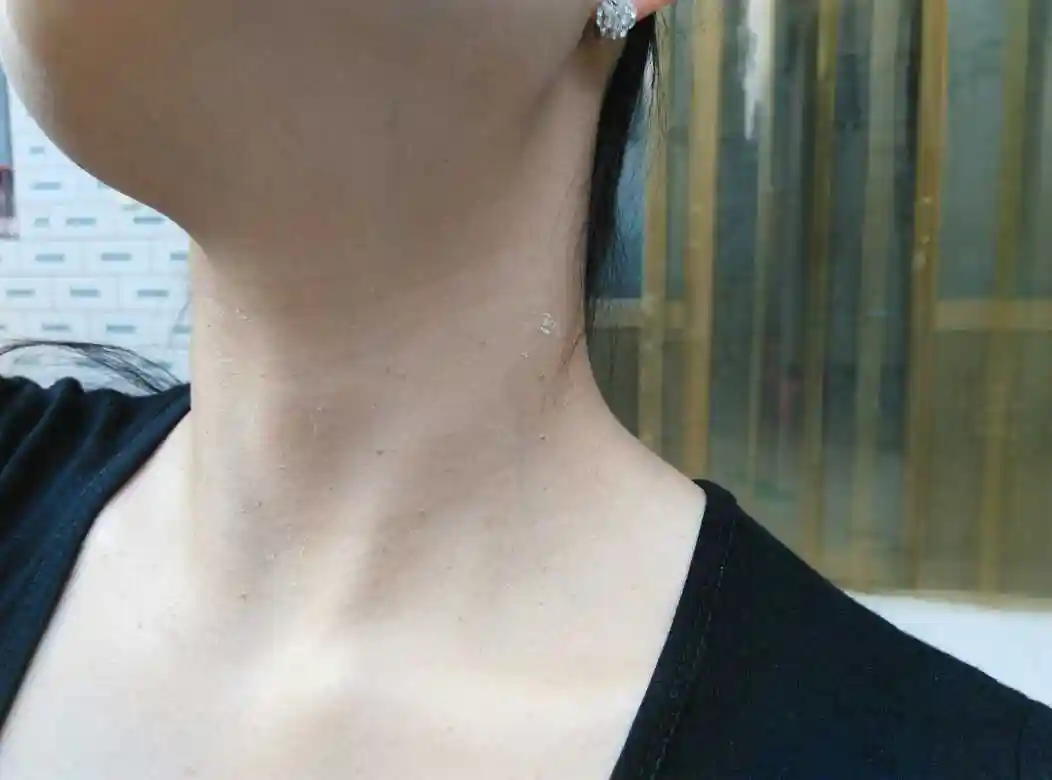 姐妹们怀孕以后有脖子里长小黑点的吗,好烦人啊😱 - 女性健康帮 -