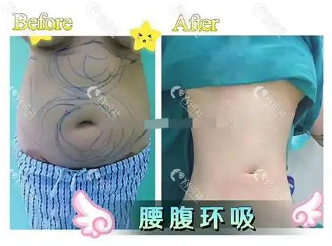 北京壹加壹医疗美容医院腰腹吸脂前后对比照片