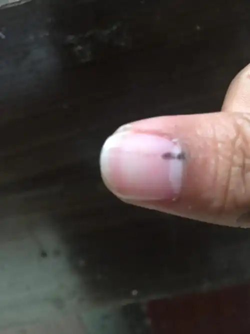 手指甲大指头里面有黑色的长长的东西,长中 在肉里面是什么啊,怎么