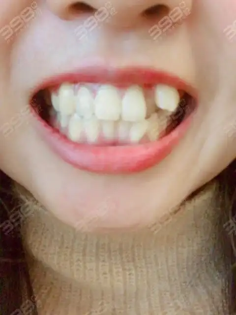 虎牙又可以叫犬牙或者尖牙,不少虎牙是因为尖牙位置受到了别的牙齿的