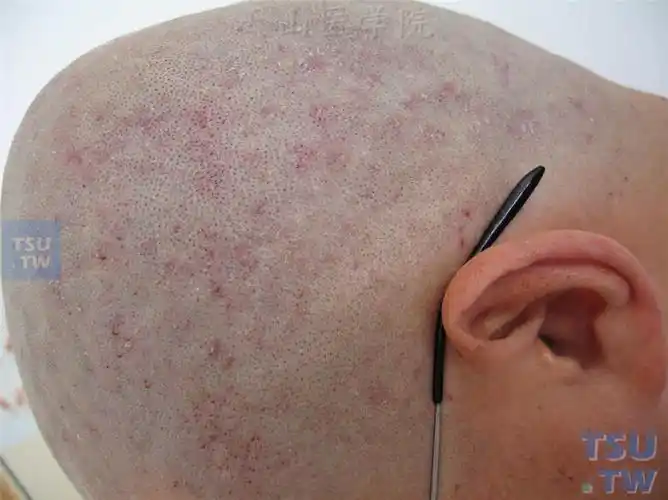脂溢性皮炎(seborrheic dermatitis)症状表现