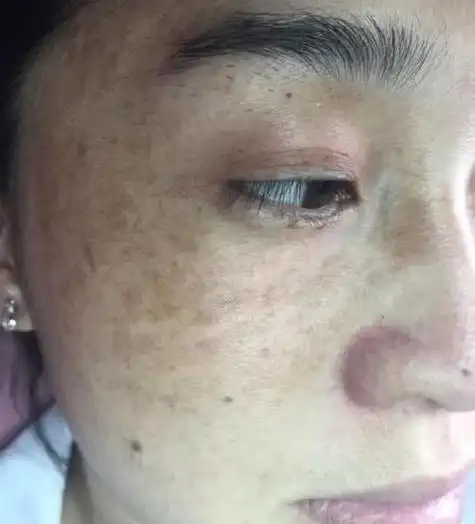 脸色暗沉发黑什么原因怎么办 —— 脸色暗沉发黑什么原因怎么办1一,肝