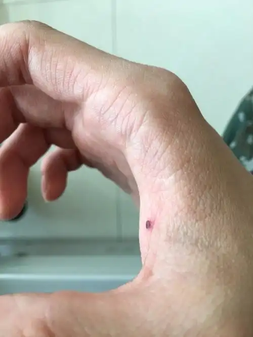 虎口突然长了个痦子.今天才发现.是什么情况